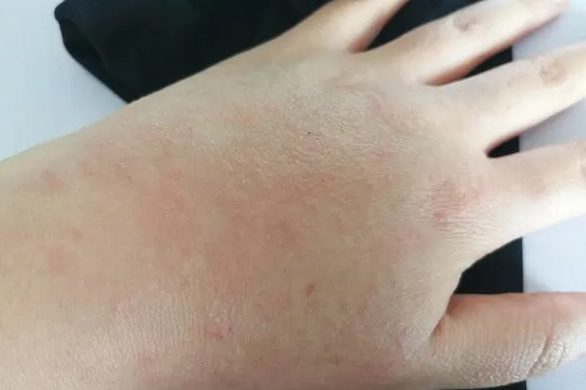齐齐哈尔太阳晒过敏怎么办