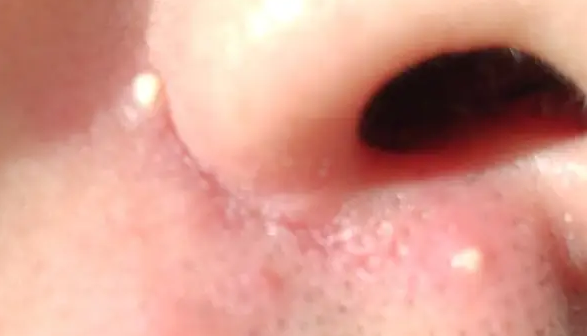 齐齐哈尔鼻子旁边长痘痘