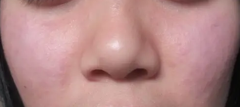 齐齐哈尔哪里能治太阳一晒就起红疹