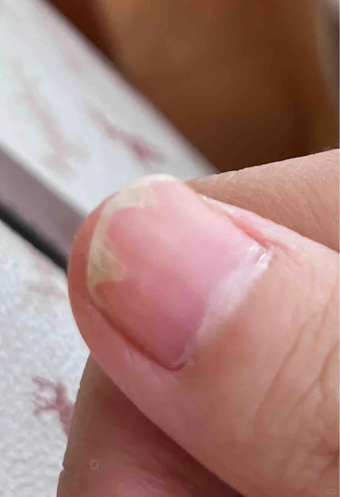 【健康】灰指甲是真菌感染！药物千万别瞎抹_得了灰指甲应该如何高效治疗？_齐齐哈尔皮肤病医院