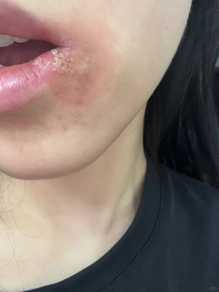 秋冬季节，警惕带状疱疹：附预防攻略_如何预防疱疹的发生？_齐齐哈尔皮肤病医院