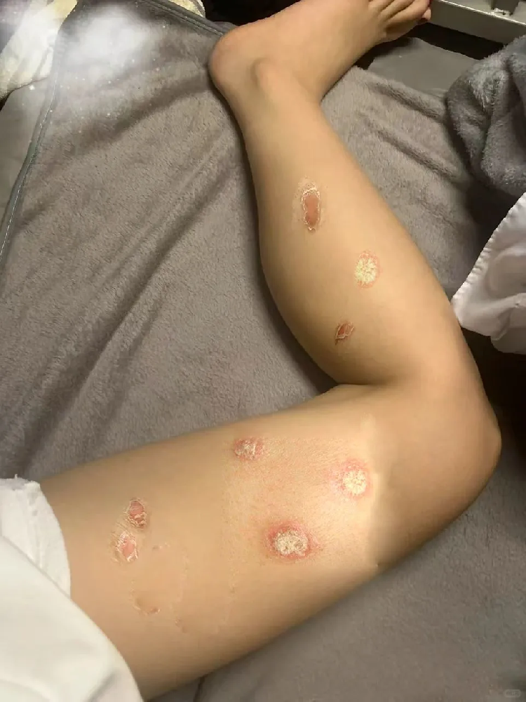 牛皮癣分类、预防、治疗、最全的指导指南，值得收藏_齐齐哈尔牛皮癣种类分为多少种？_齐齐哈尔牛皮癣医院_齐齐哈尔皮肤病医院