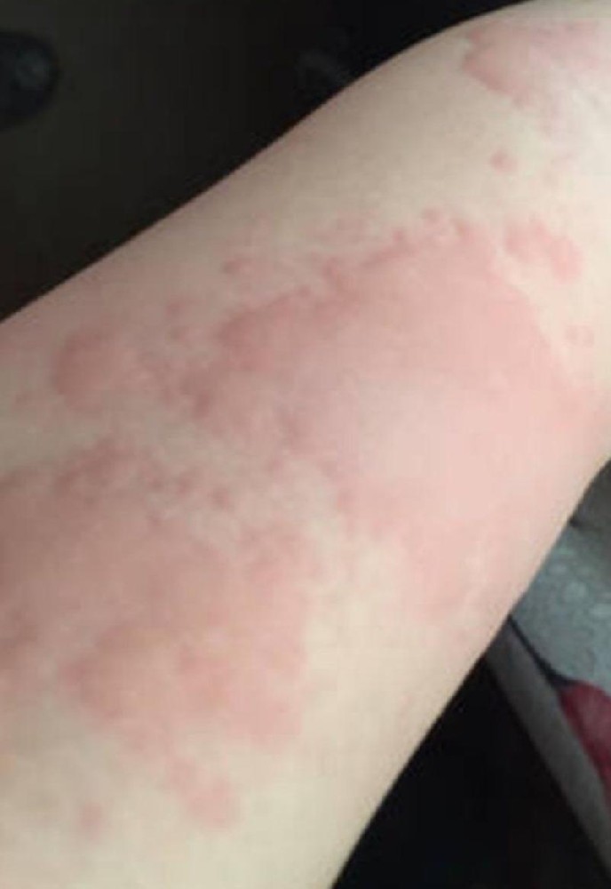 预防荨麻疹，守护健康每一天！_齐齐哈尔人该如何预防荨麻疹？_齐齐哈尔荨麻疹医院_齐齐哈尔皮肤病医院