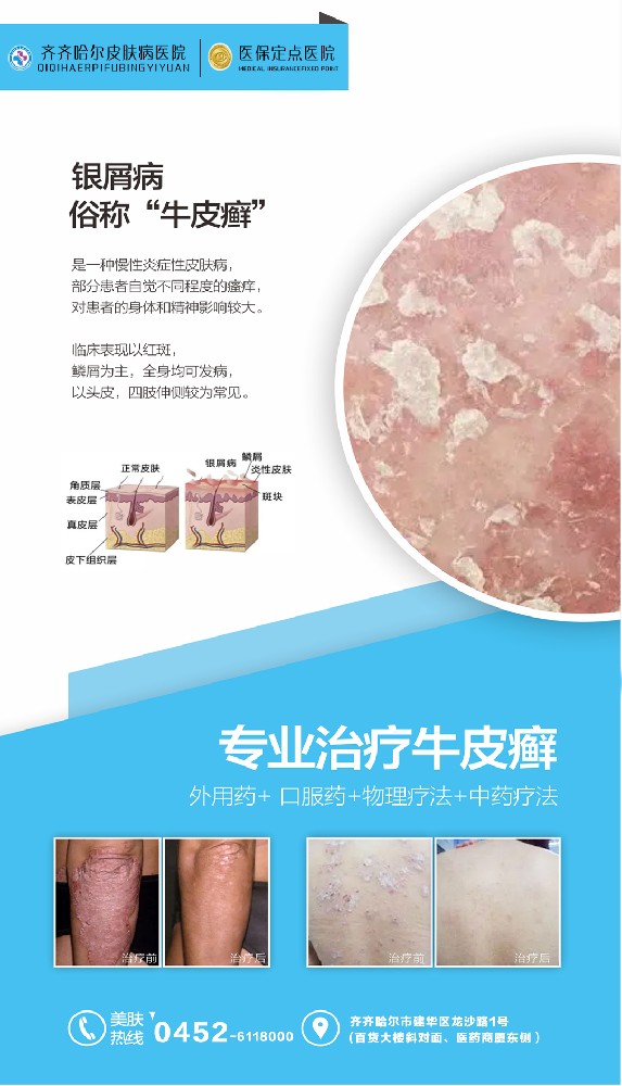 齐齐哈尔皮肤病医院：众多银屑病患者康复的见证，您的健康之选