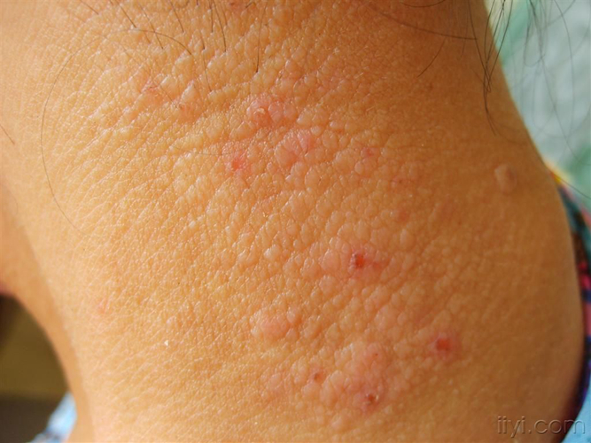 红印不掩光芒：皮炎治疗期的自卑突围战