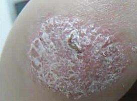 银屑病“祛癣”更“去悲”——马丽医生教你治肤又治心