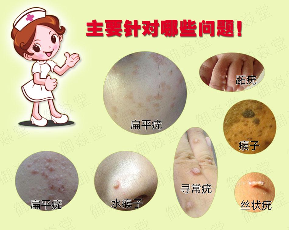 疣是怎么引起的